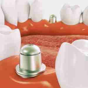 teeth replacement with dental implant