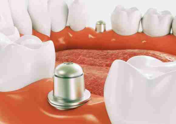 teeth replacement with dental implant
