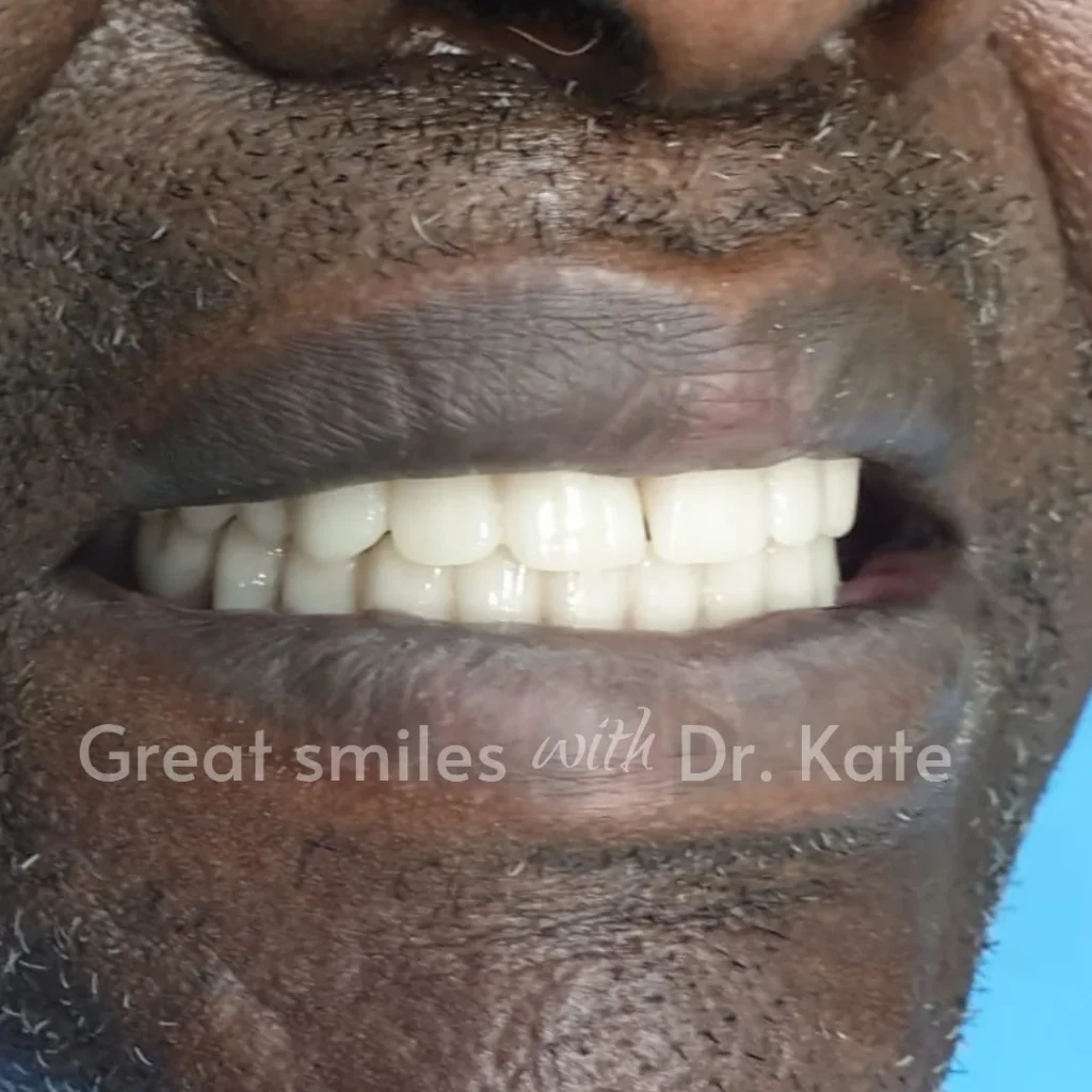dentures dental treatment in nairobi