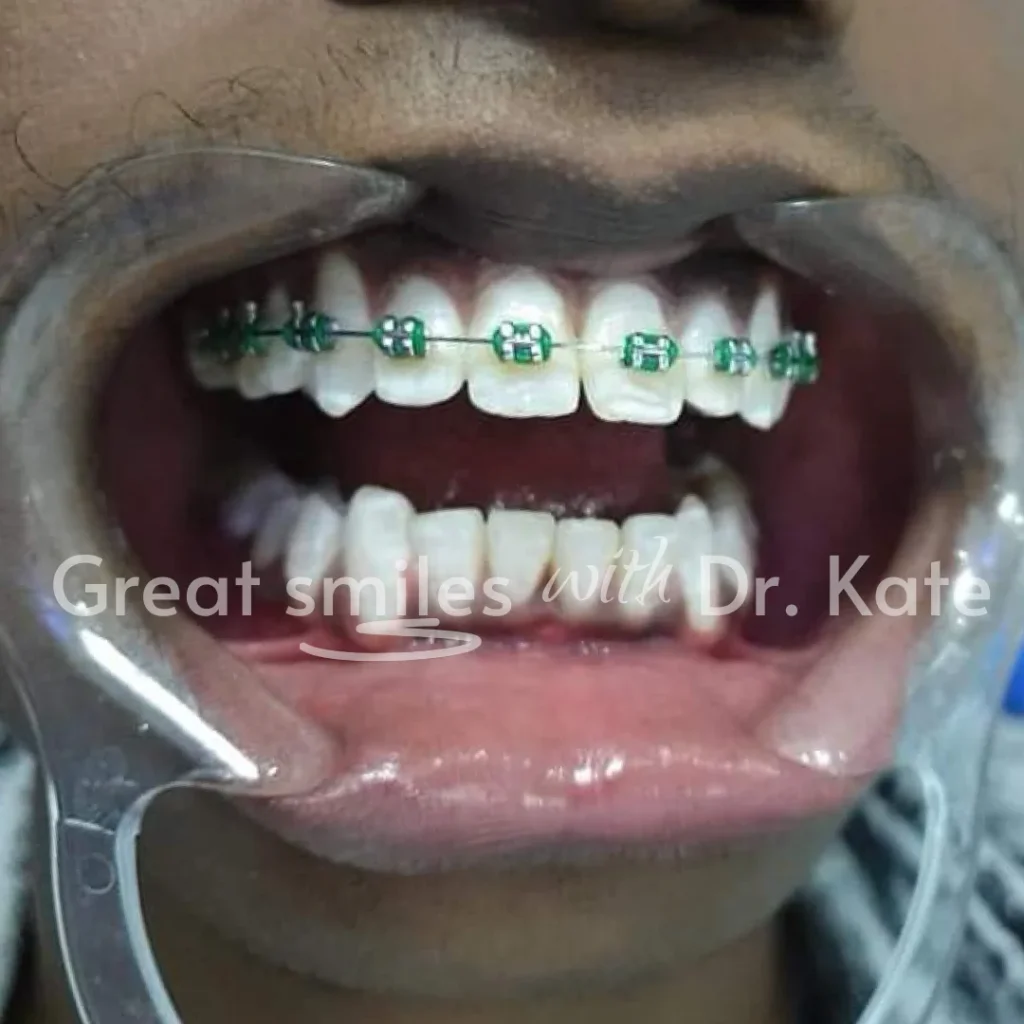 teeth alignment dental treatment in nairobi