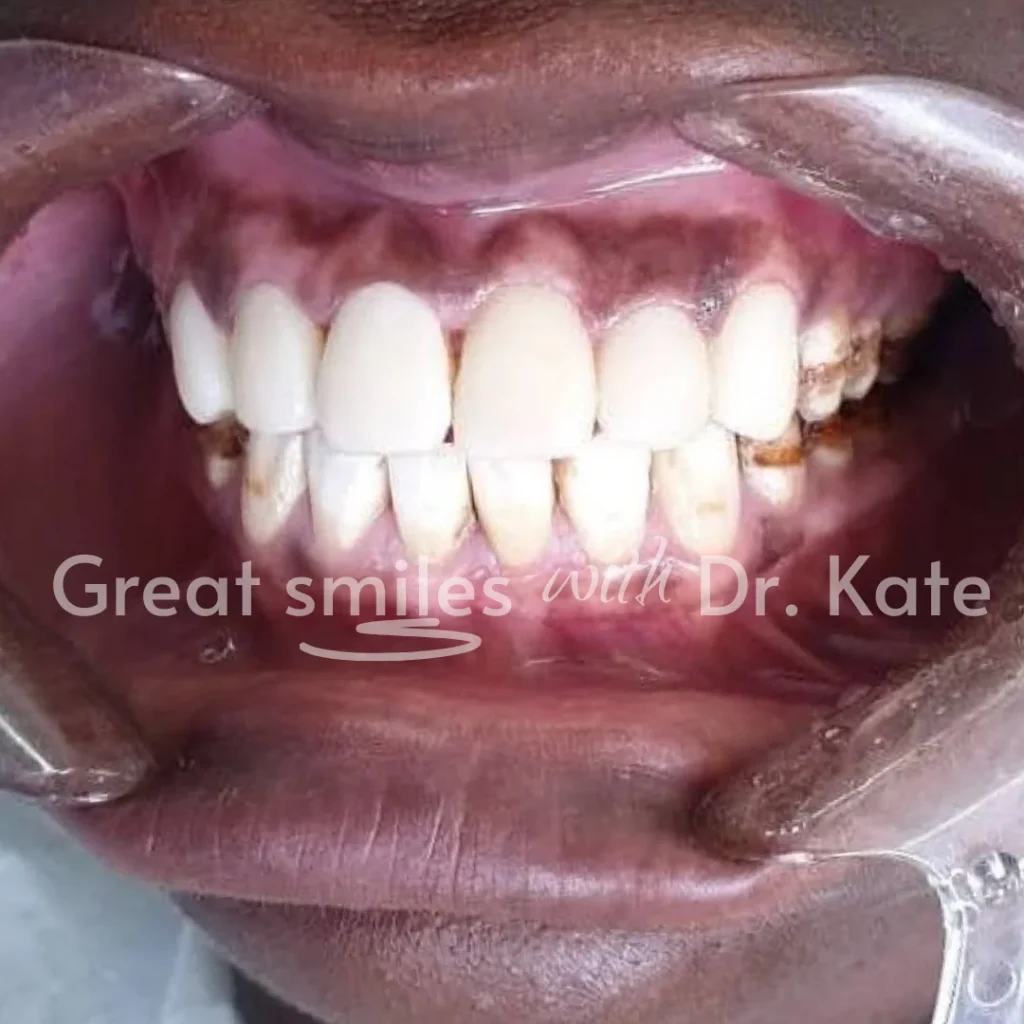 teeth whitening dental treatment in nairobi