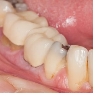 Tooth decay process, what you need to know