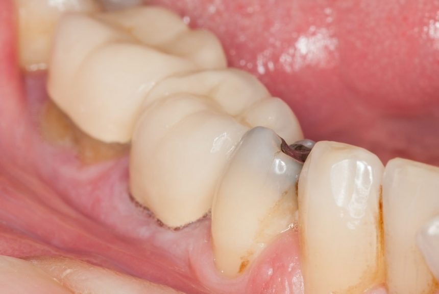 Tooth decay process, what you need to know