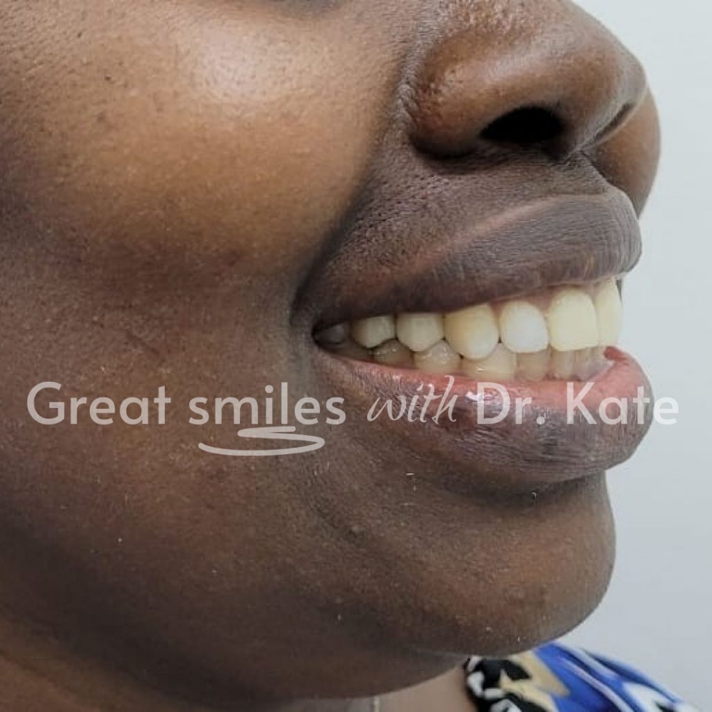 dental implants treatment in nairobi