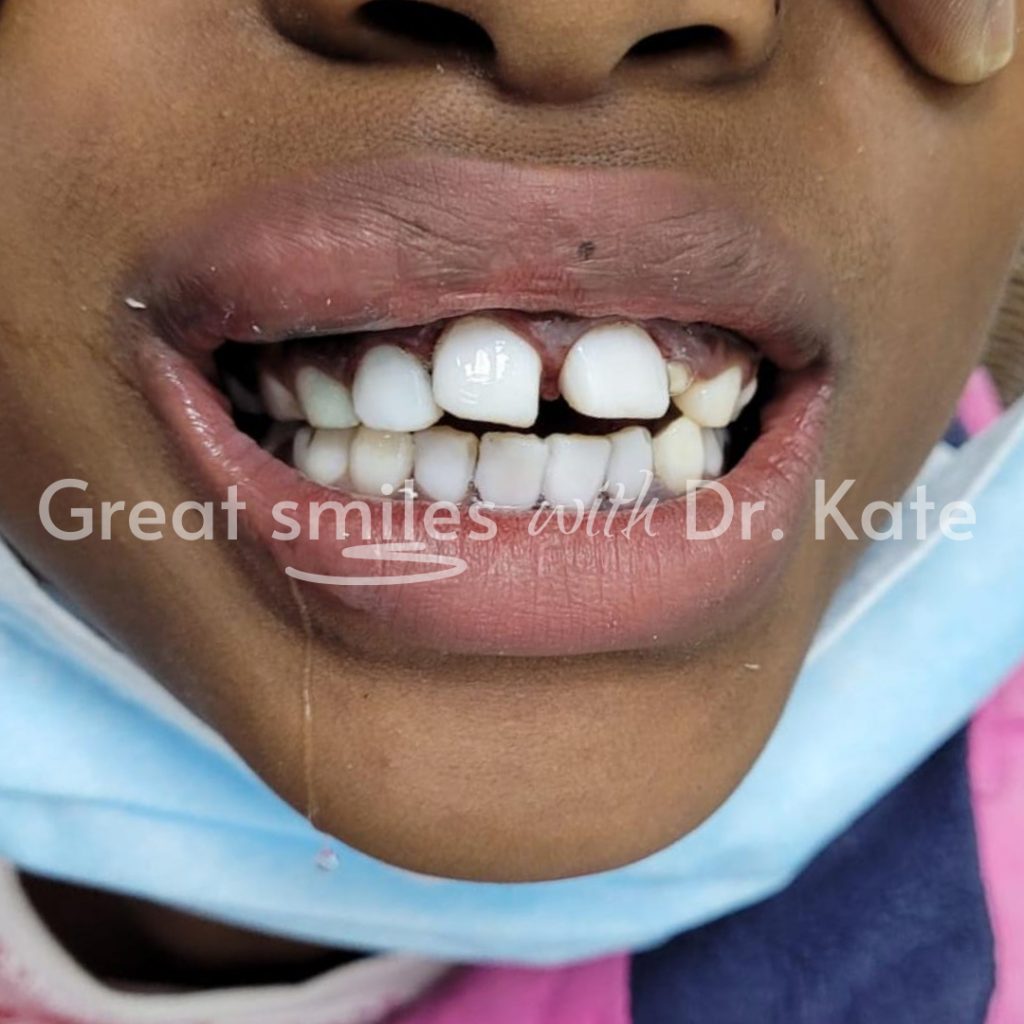 teeth whitening dental treatment in nairobi