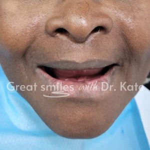 teeth replacement treatment in nairobi