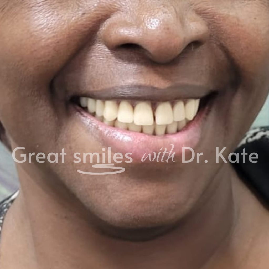 dental implants treatment in nairobi