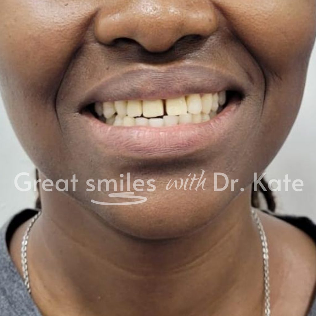 teeth replacement dental treatment in nairobi