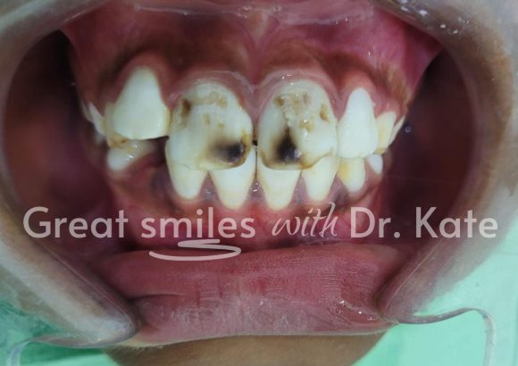 dental fluorosis