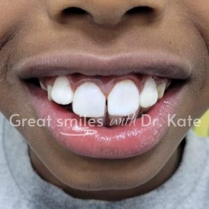 teeth whitening treatment in nairobi