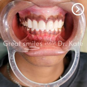dental veneers in nairobi