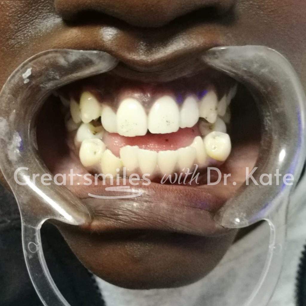 dental braces treatment in nairobi