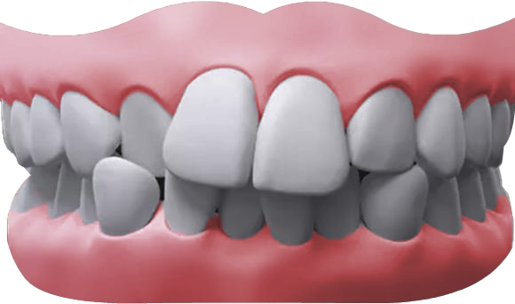 crowded teeth