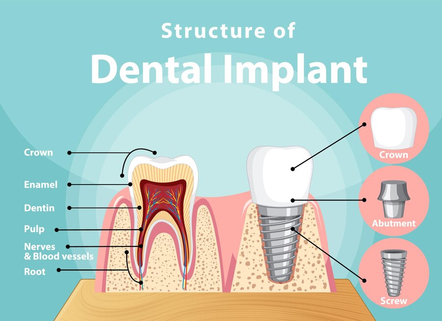 Dental Crown for Implants Illustration Courtesy of FDG