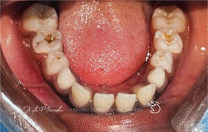 tooth decay before dental filling treatment