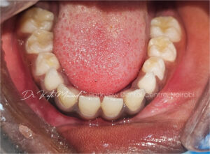after dental filling treatment for tooth decay