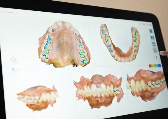 itero Lumina Scanner