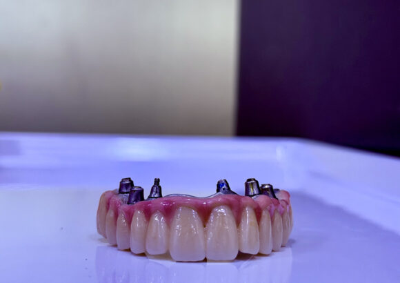 All On 6 Dental Implants
